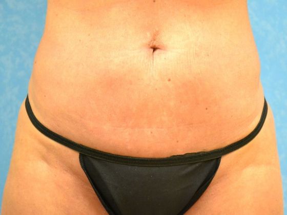 Coolsculpt: CS1714 - Sylvania, OH - After