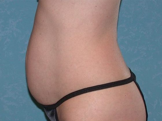 Coolsculpt: CS1418 - Lambertville, MI - Before