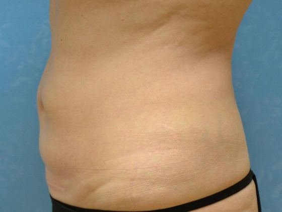 Coolsculpt: CS1321 - Toledo, OH - After