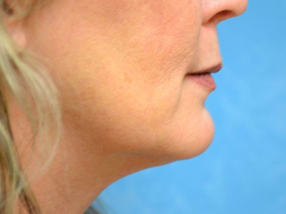 Kybella KB1711 - Toledo, OH - After