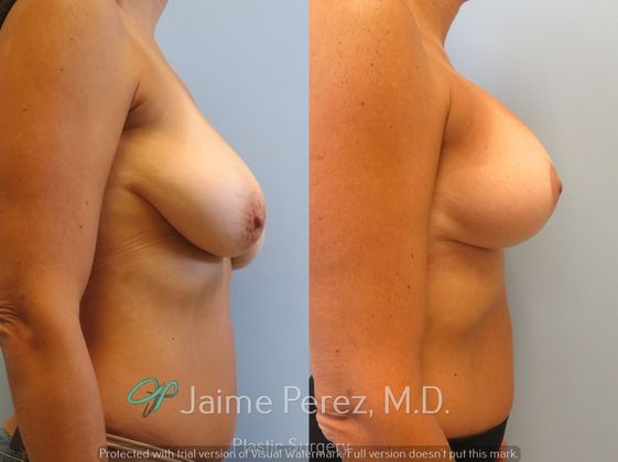 Breast Augmentation: 45-Year-Old Female: Breast Augmentation with 350cc Mentor Silicone Implants - Before & After