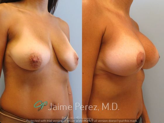 Breast Augmentation: 45-Year-Old Female: Breast Augmentation with 350cc Mentor Silicone Implants - Before & After