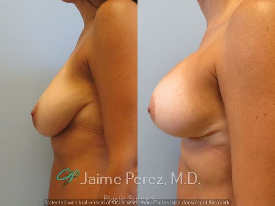 Breast Augmentation: 45-Year-Old Female: Breast Augmentation with 350cc Mentor Silicone Implants - Before & After