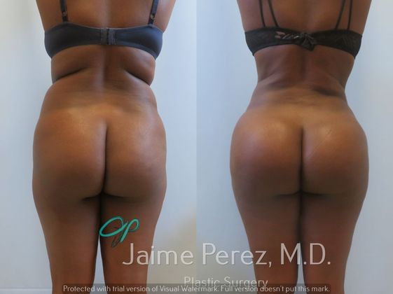 Brazilian Butt Lift: Rejuvenated with a Brazilian Butt Lift : 31-Year-Old Female - Before