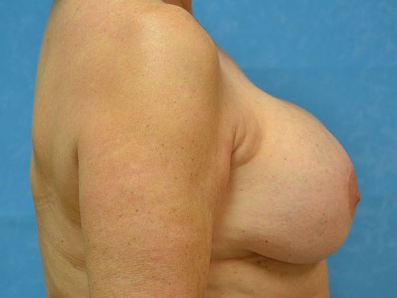 Breast Augmentation: Case 1345- Perrysburg, OH - Before