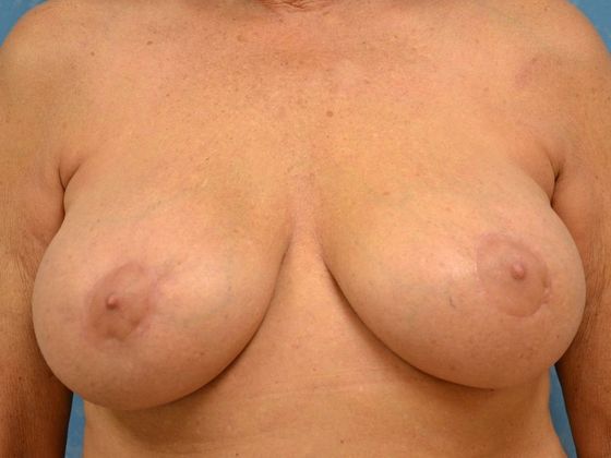 Breast Augmentation Case 1345- Perrysburg, OH - After