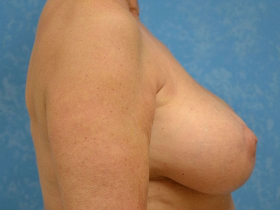 Breast Augmentation: Case 1345- Perrysburg, OH - After