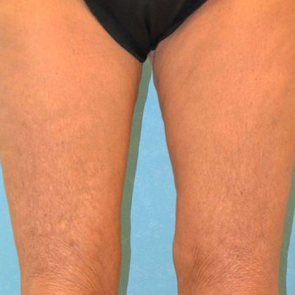 Thigh Lift Case 1404- Bowling Green, OH - After