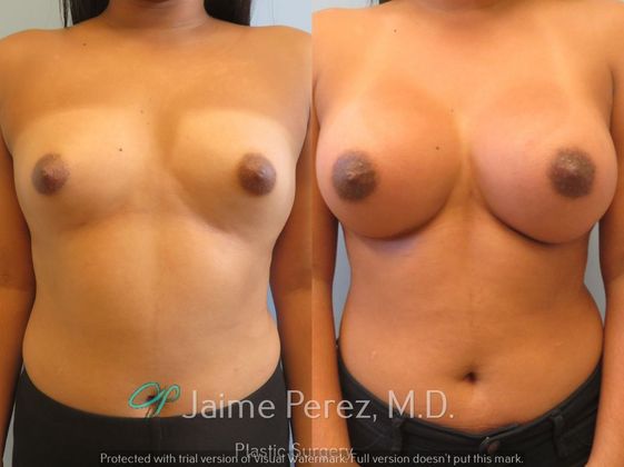Breast Augmentation: 25-Year-Old Female: Breast Augmentation using 400cc to 450cc Silicone Implants. - Before & After
