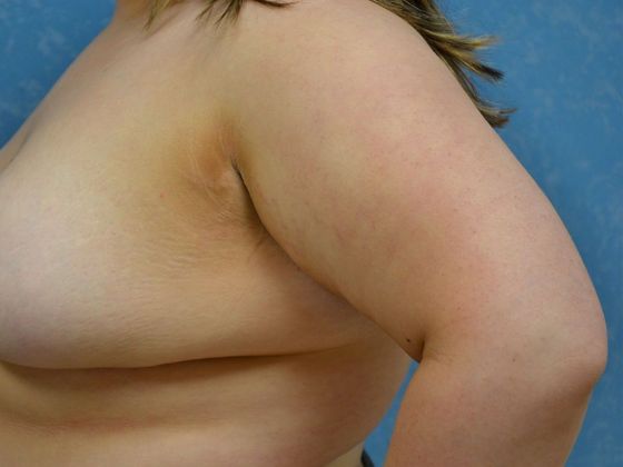 Liposuction: Case 1523- Lima, OH - Before