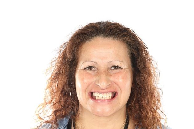 All on 4 Dental Implants Case 4  - Before