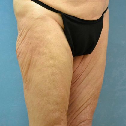 Thigh Lift Case 1405- Perrysburg, OH - Before