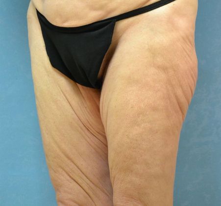 Thigh Lift: Case 1405- Perrysburg, OH - Before