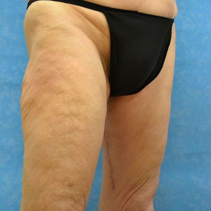 Thigh Lift Case 1405- Perrysburg, OH - After