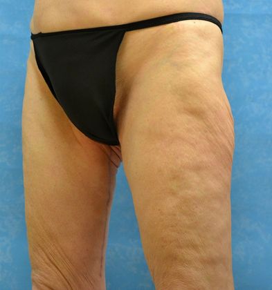 Thigh Lift: Case 1405- Perrysburg, OH - After