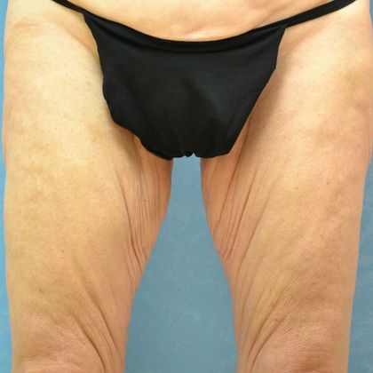 Thigh Lift: Case 1405- Perrysburg, OH - Before
