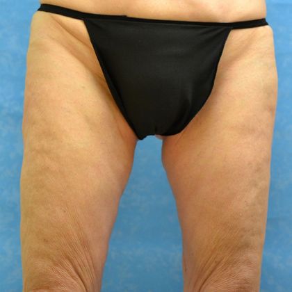 Thigh Lift: Case 1405- Perrysburg, OH - After