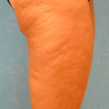 Thigh Lift: Case 1404- Bowling Green, OH - Before