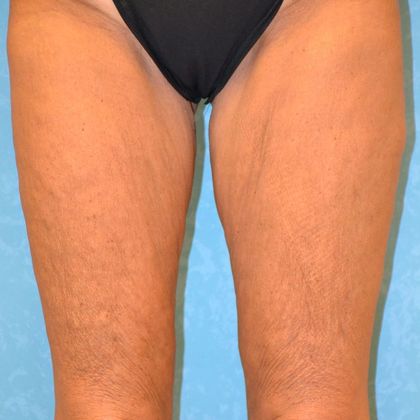 Thigh Lift Case 1404- Bowling Green, OH - Before
