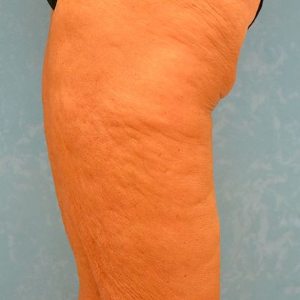 Thigh Lift: Case 1404- Bowling Green, OH - Before