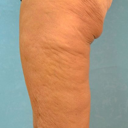 Thigh Lift: Case 1404- Bowling Green, OH - After