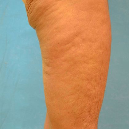 Thigh Lift: Case 1404- Bowling Green, OH - After