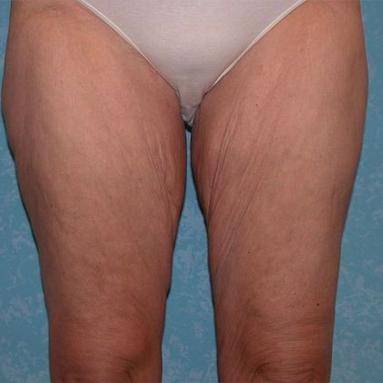 Thigh Lift TL1403 - Bowling Green, OH - Before