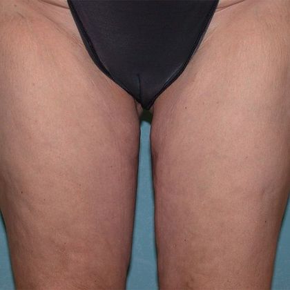 Thigh Lift TL1403 - Bowling Green, OH - After
