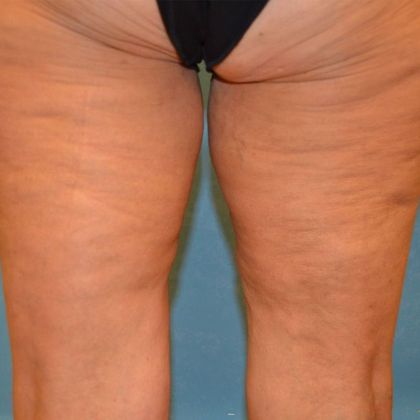 Thigh Lift TL1301 - Toledo, OH - Before
