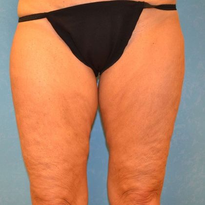 Thigh Lift: TL1301 - Toledo, OH - Before