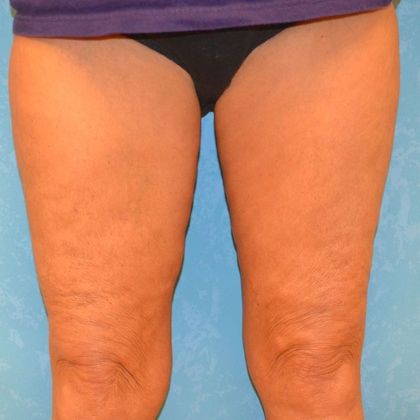 Thigh Lift: TL1301 - Toledo, OH - After
