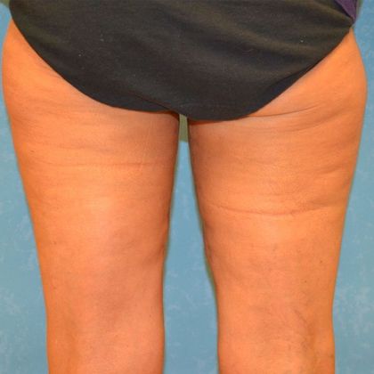 Thigh Lift TL1301 - Toledo, OH - After