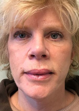 Facelift: Case 10 - Necklift Greenwich - After