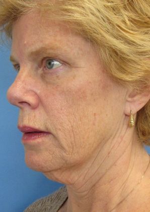 Facelift: Case 10 - Necklift Greenwich - Before