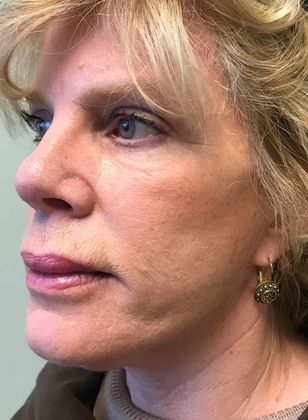 Facelift: Case 10 - Necklift Greenwich - After