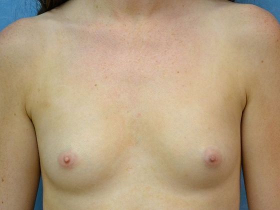 Breast Augmentation Case 1349- Perrysburg, OH - Before