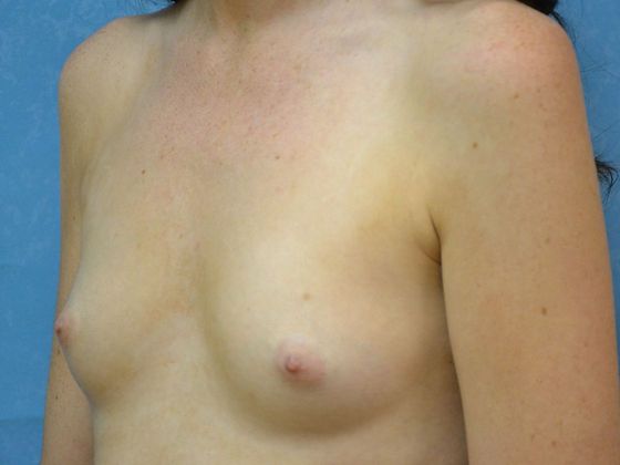 Breast Augmentation: Case 1349- Perrysburg, OH - Before