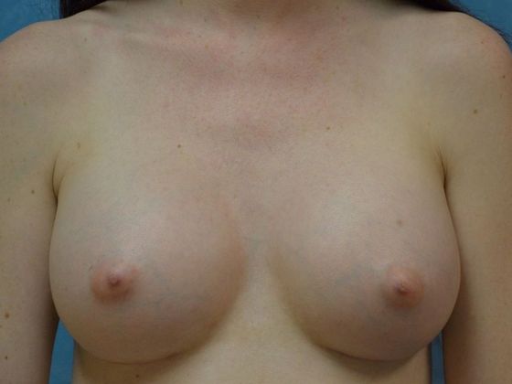 Breast Augmentation Case 1349- Perrysburg, OH - After