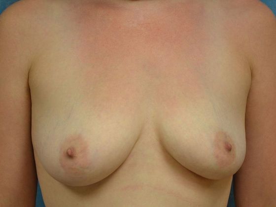Breast Augmentation Case 1350- Toledo, OH - Before