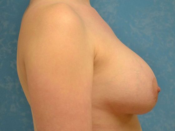 Breast Augmentation: Case 1350- Toledo, OH - After