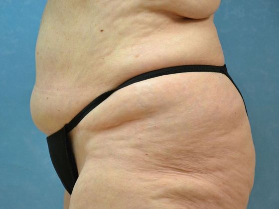 Liposuction: Case 1524- Toledo, OH - Before
