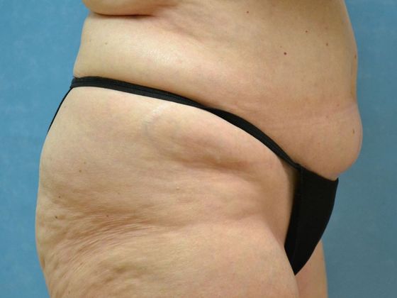 Liposuction: Case 1524- Toledo, OH - Before