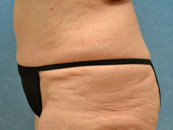 Liposuction: Case 1524- Toledo, OH - After