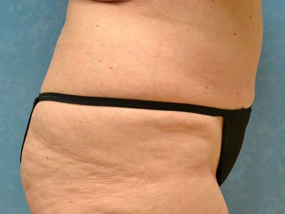 Liposuction: Case 1524- Toledo, OH - After