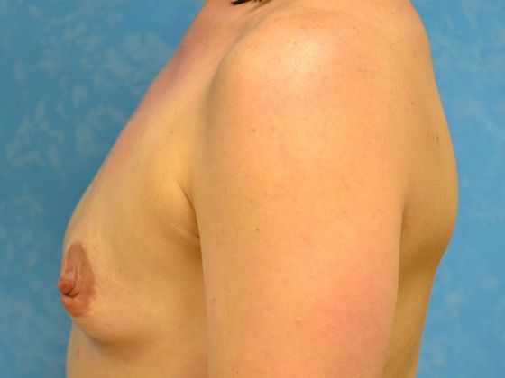 Breast Augmentation: Case 1352- Metamora, OH - Before