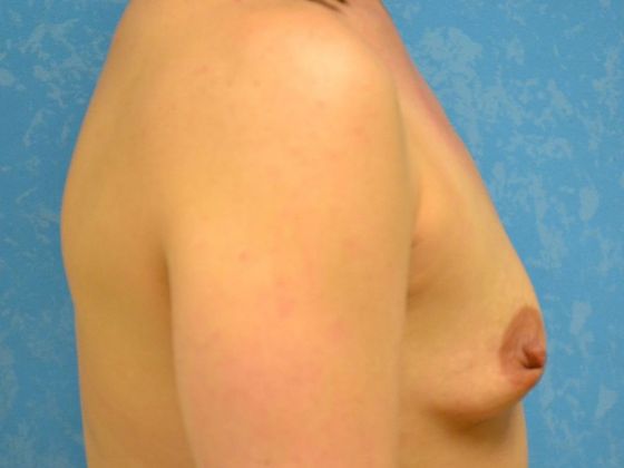 Breast Augmentation: Case 1352- Metamora, OH - Before