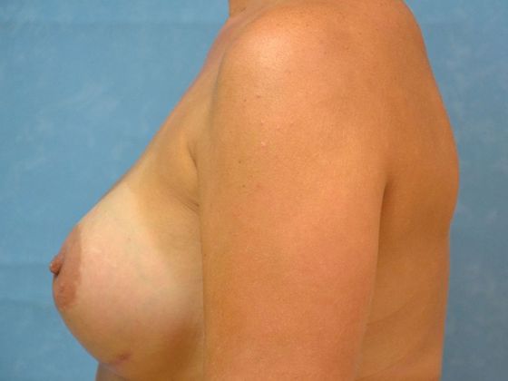 Breast Augmentation: Case 1352- Metamora, OH - After