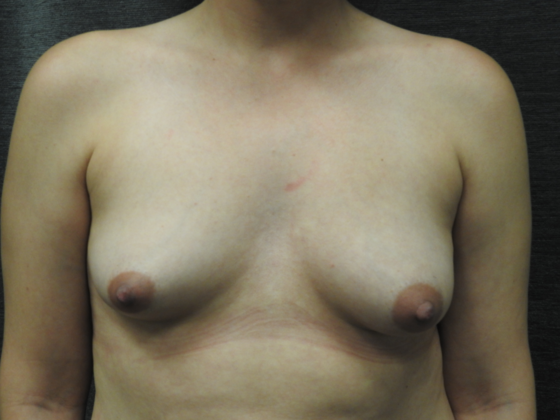 Breast Lift Case 9 - San Antonio - Before
