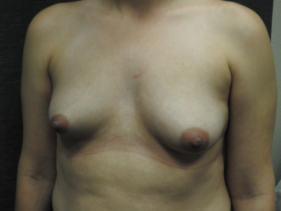 Breast Lift: Case 9 - San Antonio - Before