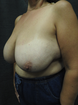 Breast Lift Case 16 - San Antonio - Before
